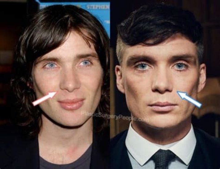 Cillian Murphy Nose Did He Underwent Surgery?
