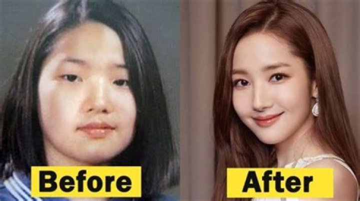 Did Yeonmi Park Undergo Plastic Surgery in Real?