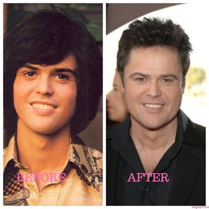 Donny Osmond Plastic Surgery Photos [Before & After] ⋆ Surgery4