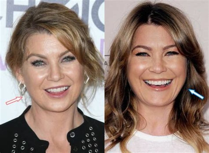 Ellen Pompeo Plastic Surgery Botox, Facelift, Lip scar, Lip injection