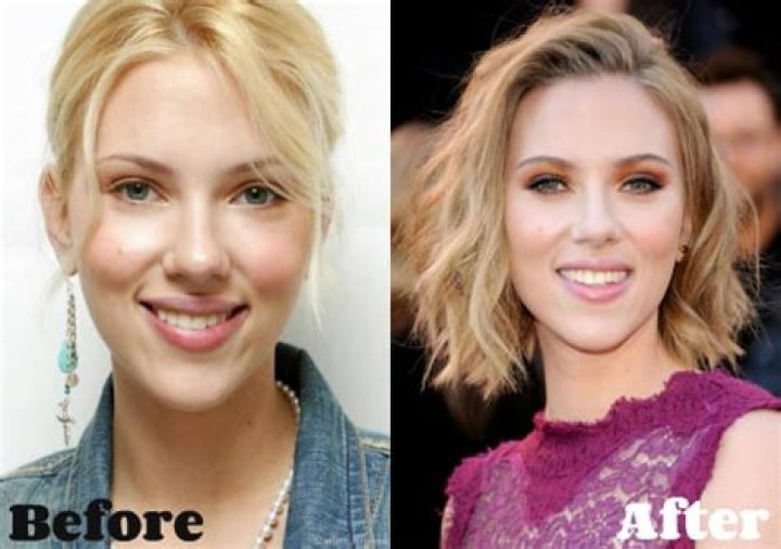 Scarlett Johansson Breast Reduction Plastic Surgery Before and After