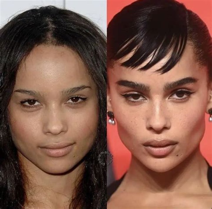 Zoe Kravitz Plastic Surgery How Many Plastic Surgeries She Had? Lake